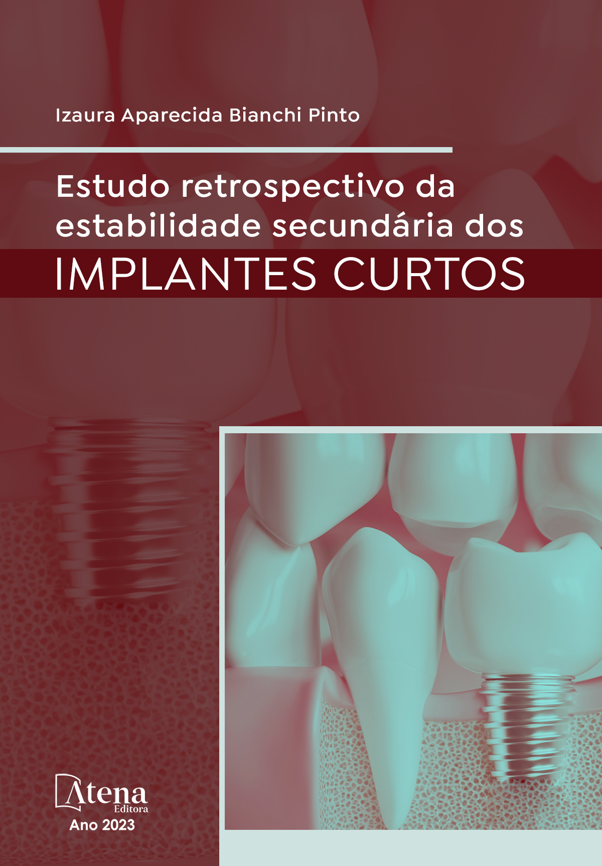 Estudo retrospectivo da estabilidade secundária dos implantes curtos